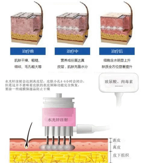 光子和水光到底能不能一起做？终于有人讲清楚了