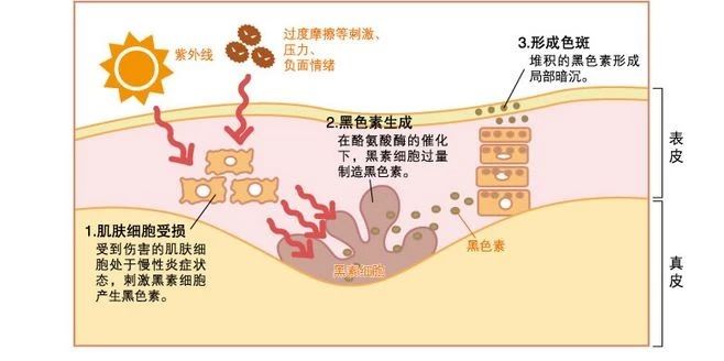 什么是色沉色斑？色斑都包括哪些？