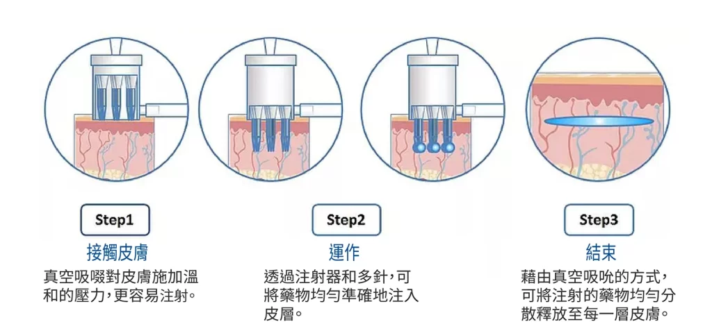 水光作用、功效、水光作用原理，水光与普通面膜区别