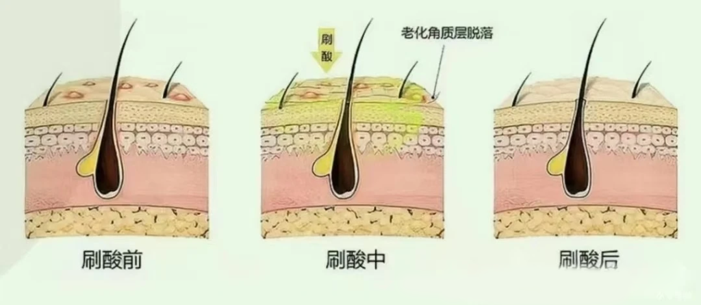 面部刷酸的作用与注意事项