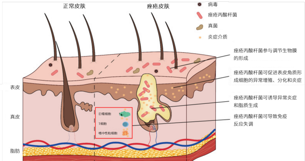 水光治疗后爆痘是怎么回事？爆痘后需要即刻干预吗？