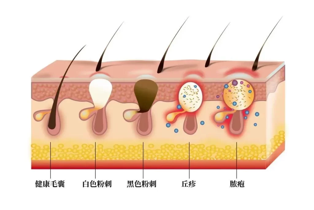 为什么有些痘痘反反复复好不了，怎么办？怎么治？