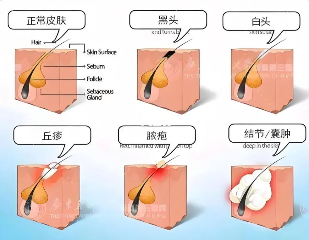 揭秘痤疮成因：内源性与外源性因素全解析