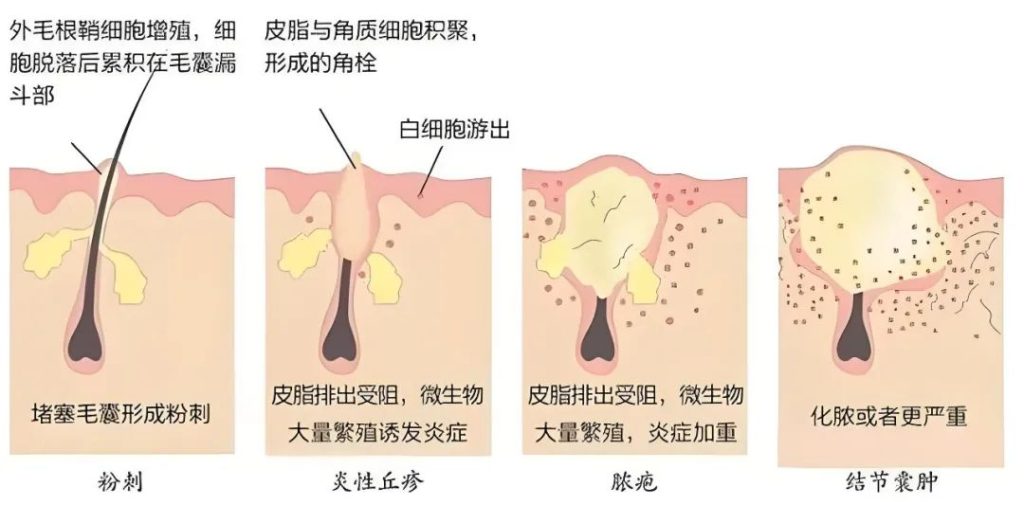 揭秘痤疮成因：内源性与外源性因素全解析