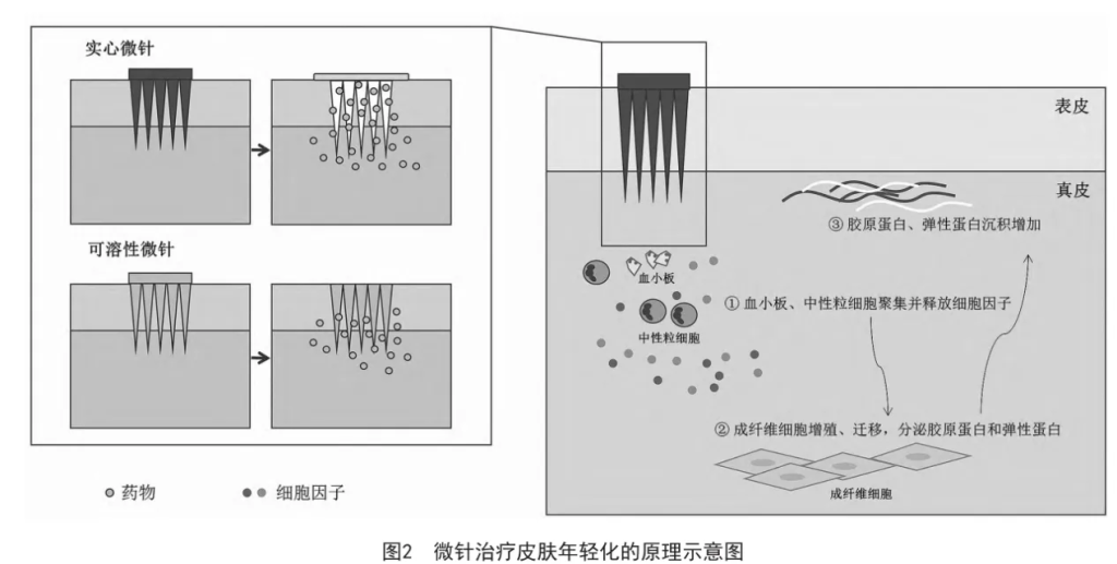 微针疗法您知多少？微针术后不良反应又该如何处理呢？