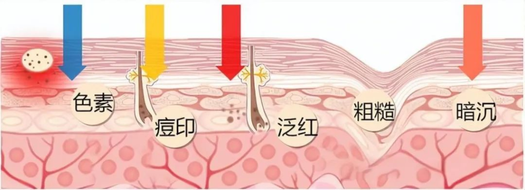 美肤指南 | 第七代AOPT黄金超光子——医美护肤界的“万金油”