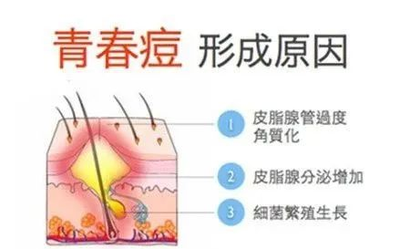 不同部位长痘痘的皮肤管理知识