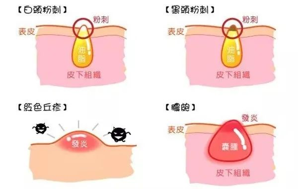 痘痘的形成过程及原因！