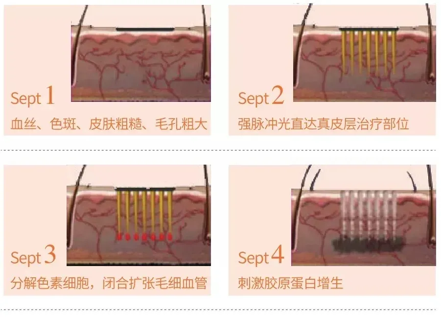 光子嫩肤只做一次就有效果？