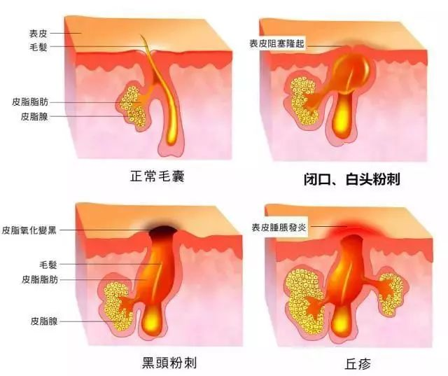 痘痘会不会自己好？长痘痘了怎么办？