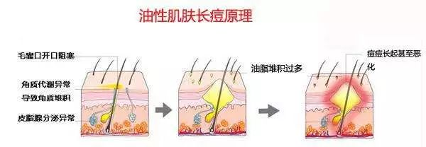 痘印该怎么护理？去除痘印